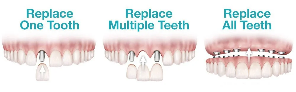 Implant For Each