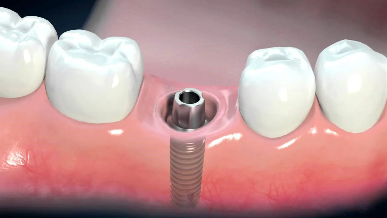What Are Dental Implants